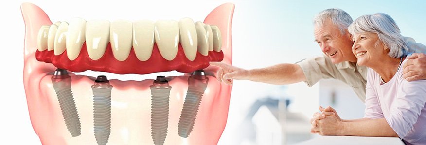 4 İmplant ile Sabit Diş Yöntemi (All on 4)