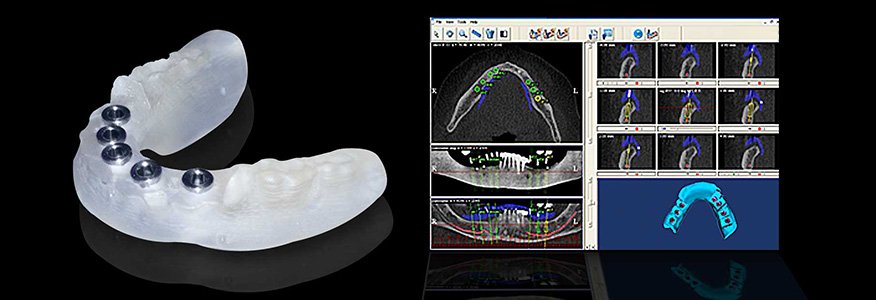 Bilgisayar İle Gelişmiş İmplant Tedavi Planlaması