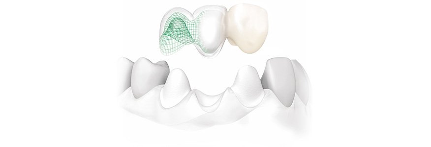 Cad-Cam Yöntemi İle Diş Yapımı