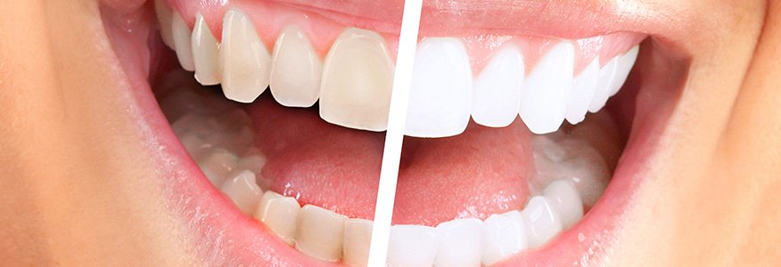 Diş Beyazlatma Nedenleri