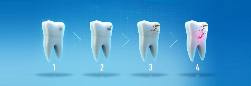 Diş Çürüğü Nedir ve Çürük Belirtileri Nelerdir?