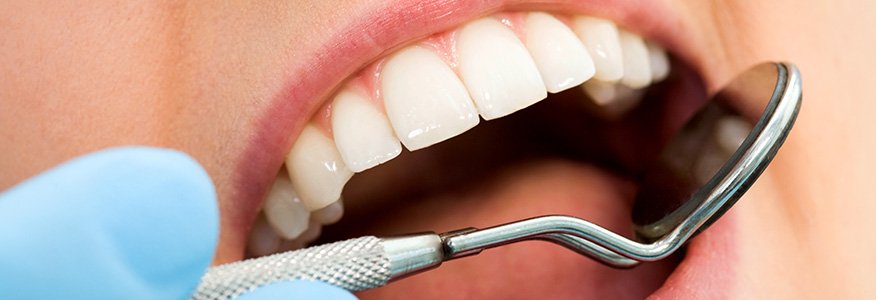 Diş Dolguları Hakkında Sık Sorulanlar