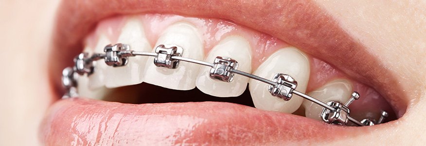 Klasik braketler ile ortodontik tedavi