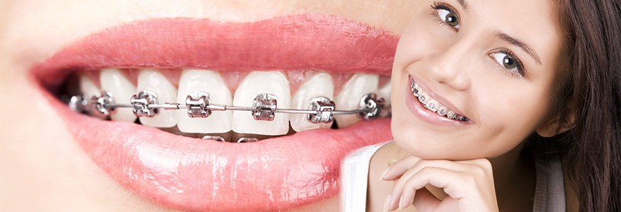 Ortodontik Tedavi Aşamaları